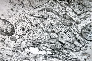 F,25y. | giant multinuclear osteoclast - aneurysmatic cyst - tibia F,25y. | giant multinuclear osteoclast - aneurysmatic cyst - tibia